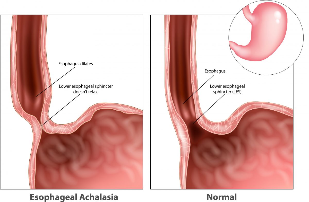 Image result for achalasia disorder