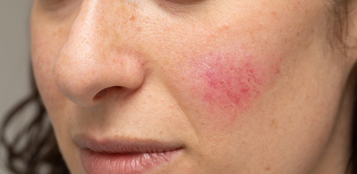 View Acne Rosacea
 PNG