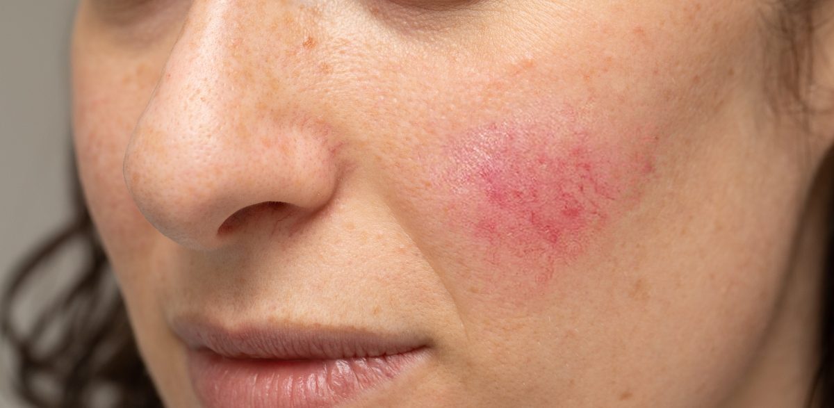  rosacea skin care