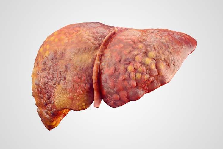 Image of liver with cirrhosis