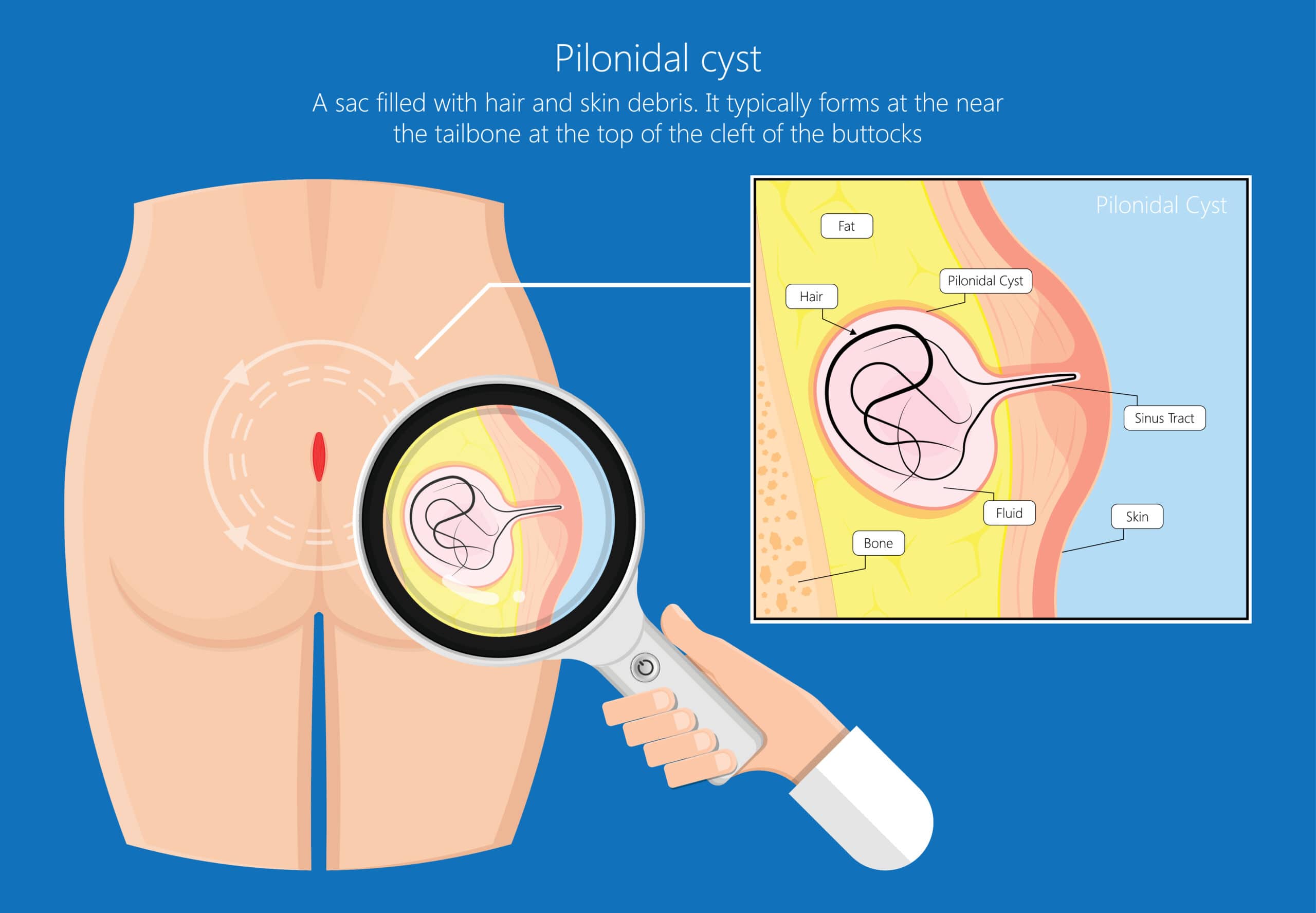 Video: Pilonidal disease - Dr Naseem Video: Pilonidal disease - Dr Naseem