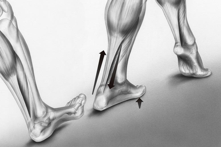 Achilles tendinitis - myDr.com.au