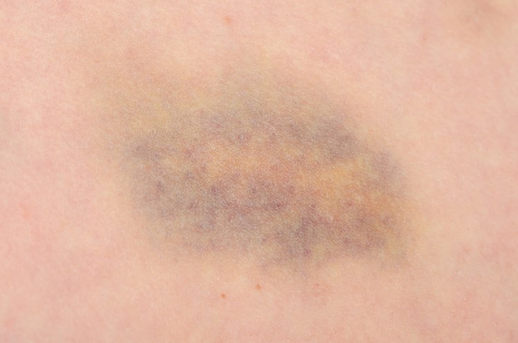 Spider veins, bruises and scars