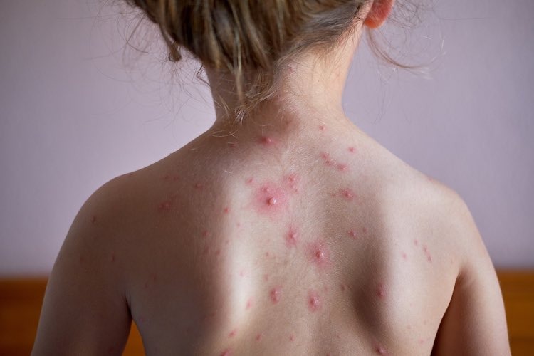 chicken pox pictures in adults