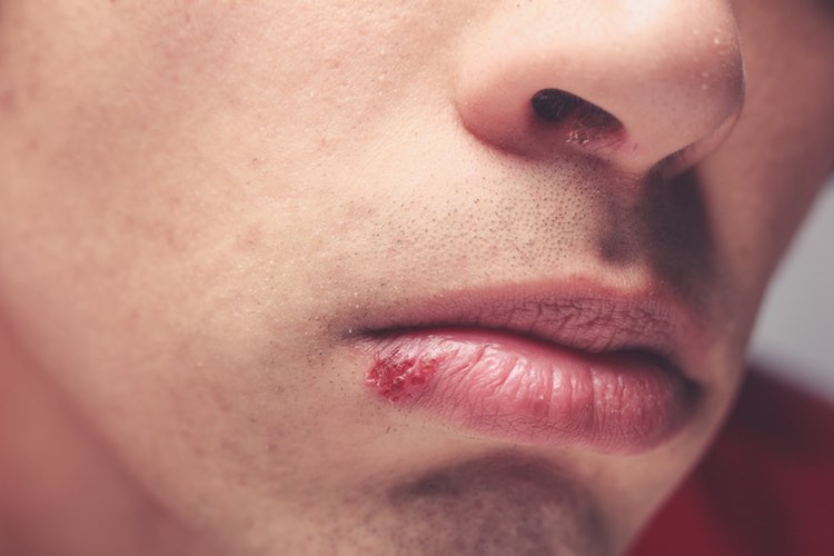 Cold Sores Self Care Mydr Com Au