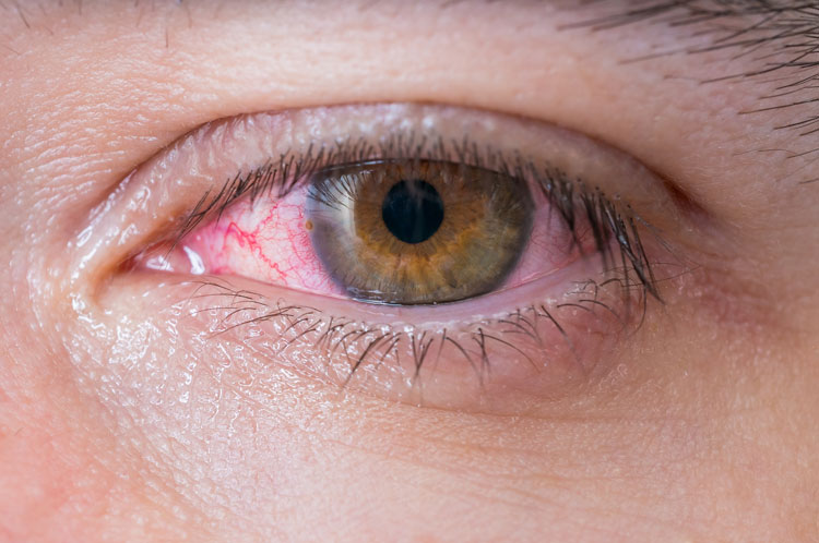 Conjunctivitis selfcare
