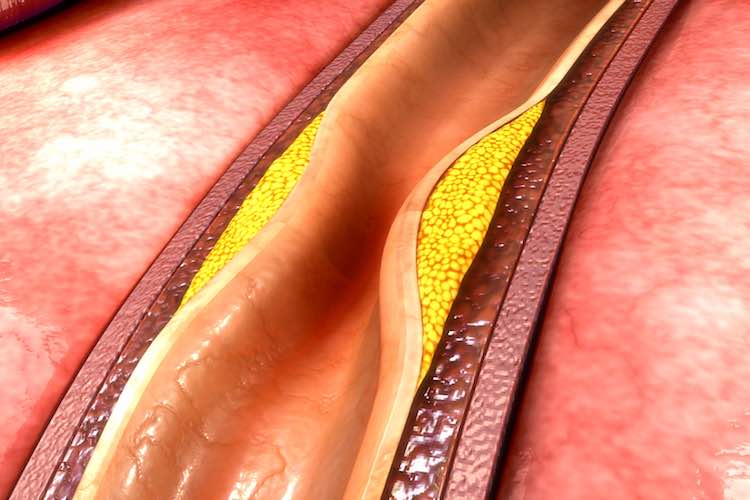 Coronary artery bypass surgery - myDr.com.au