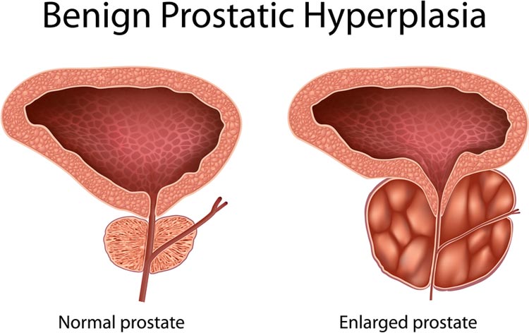 enlarged prostate in your 20s reddit vezica urinara inflamata tratament
