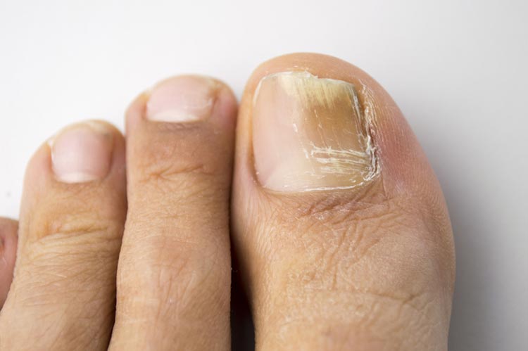 toe nail fungus australia