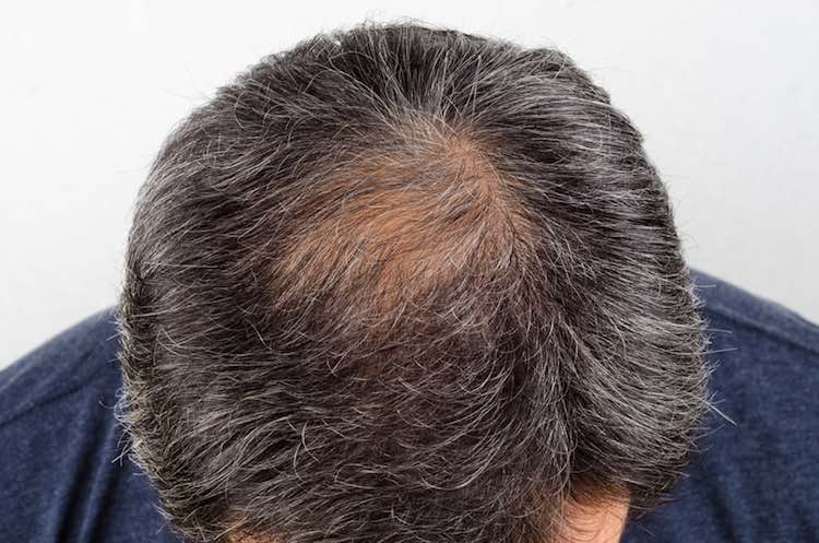 Hair Loss Self Care Mydr Com Au