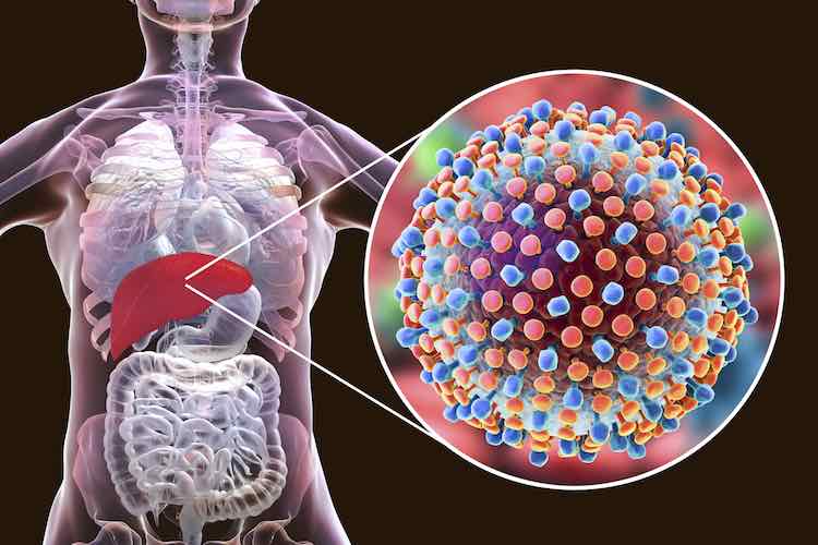 Hepatitis: an overview - myDr