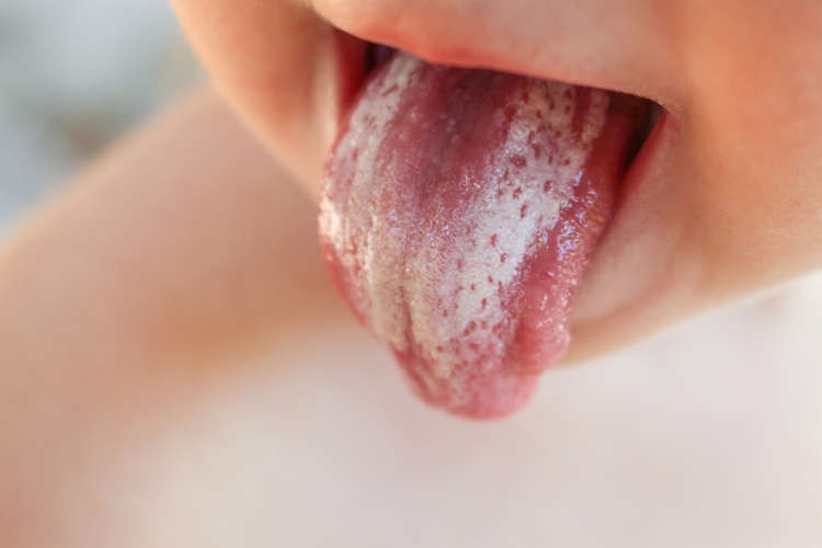 Oral thrush - MyDr.com.au Oral thrush - MyDr.com.au