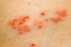 Shingles increases the risk of stroke for several years after - myDr.com.au