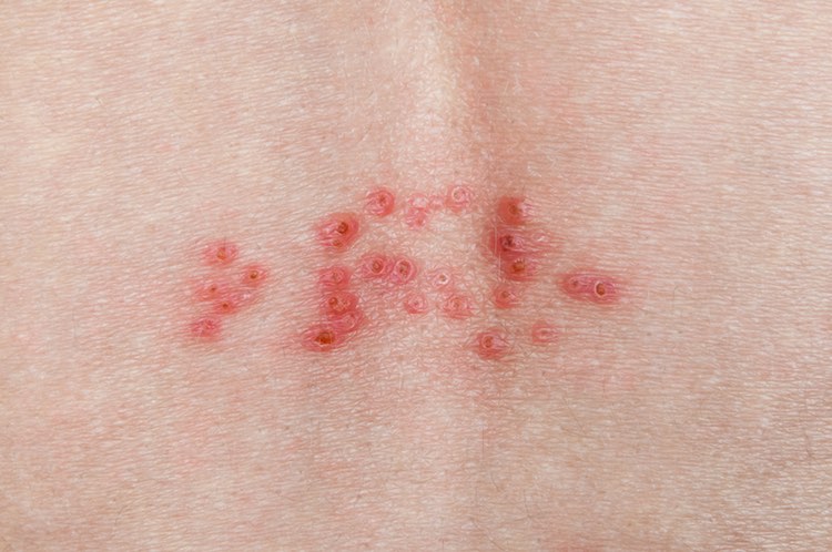 Treatment Of Herpes Zoster In Elderly