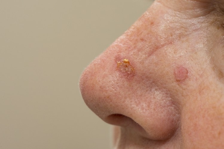Why Is The Skin Inside My Nose Peeling