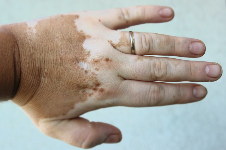 Vitiligo - MyDr.com.au