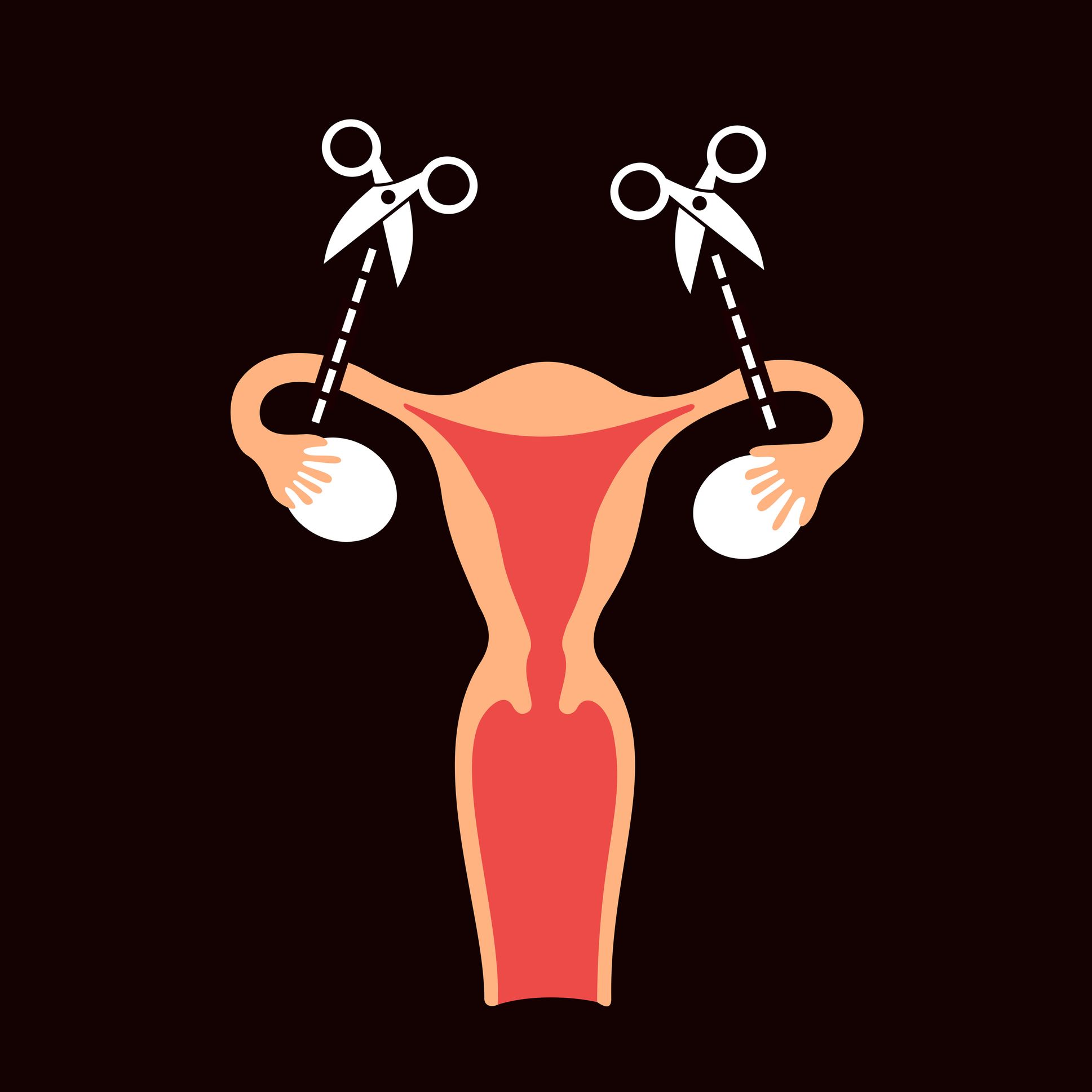 contraception female surgical sterilisation mydr com au