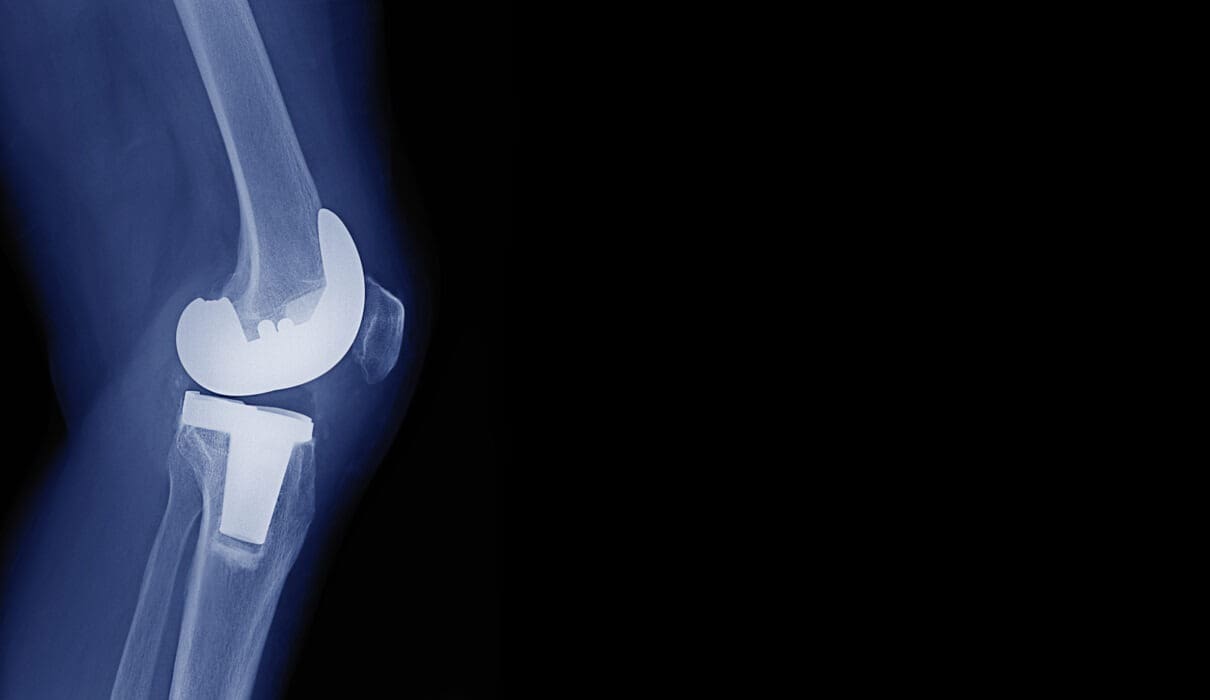 How long do hip and knee replacements last?