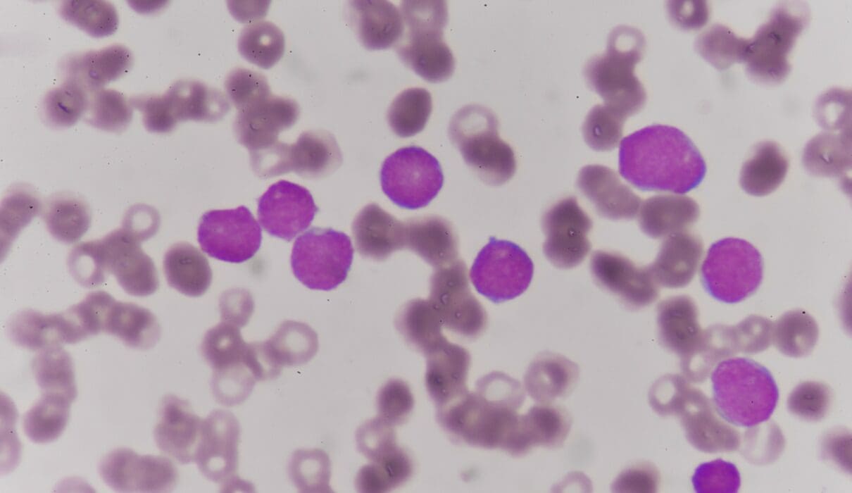 Some rare cancer examples