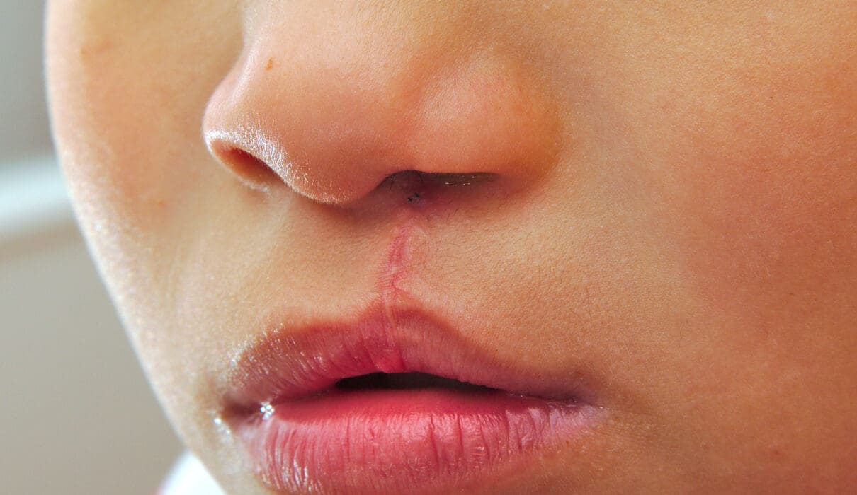 What is a Cleft Palate and Who Does it Effect?