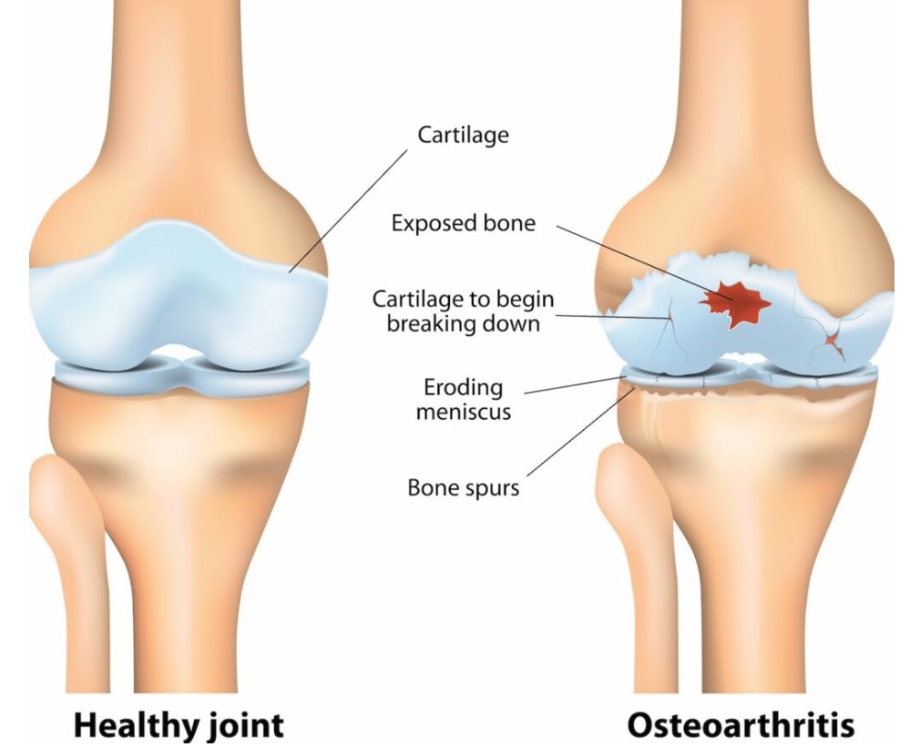 hatékony gyógyszer a nyaki osteochondrozisra